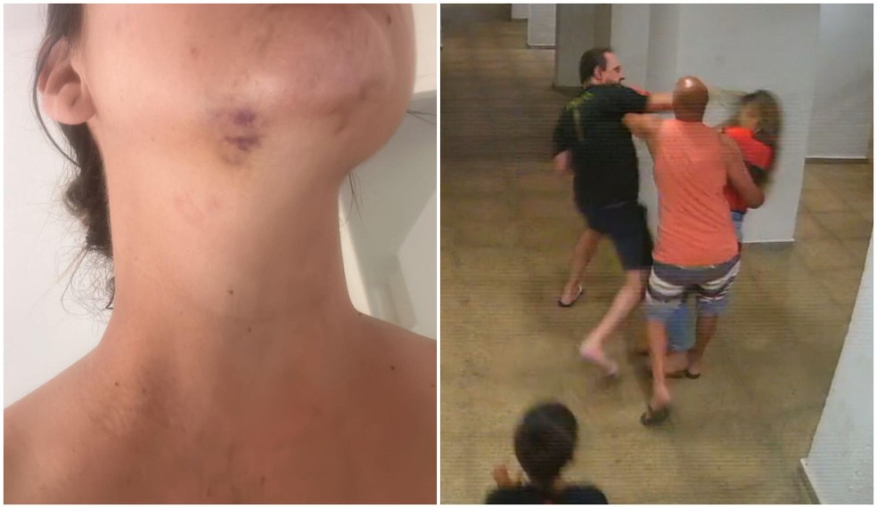 Comerciante mostra hematoma causado por chute e agressão de vizinho, durante briga em condomínio de Guarulhos, na Grande SP, em 24 de setembro de 2023. Filho da vítima de 8 anos presenciou agressões. — Foto: Reprodução