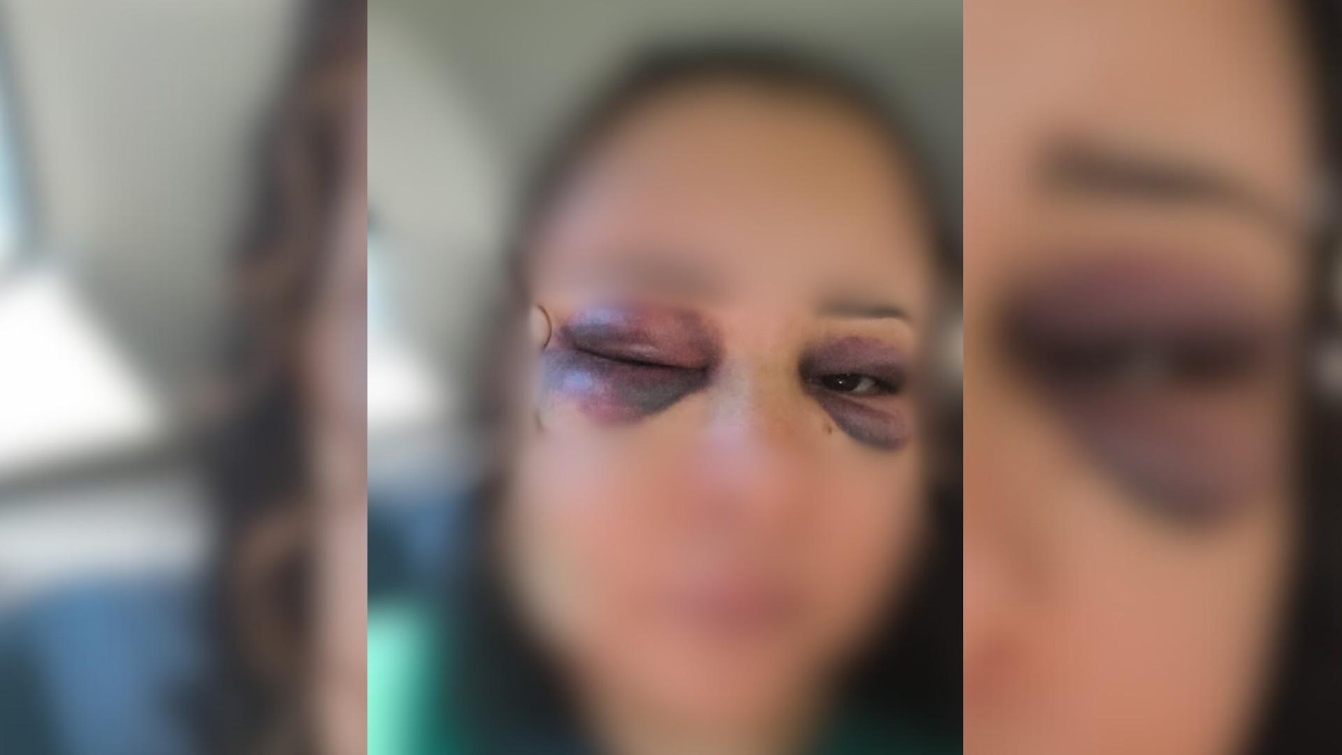 Mulher tem fratura no nariz e no maxilar após ser espancada por homem dentro de apartamento em Rio Preto 