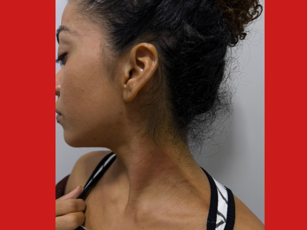 Érica detalhou que ficou com marcas no pescoço, hematomas nos braços e peito, e dores nas costas — Foto: Arquivo pessoal