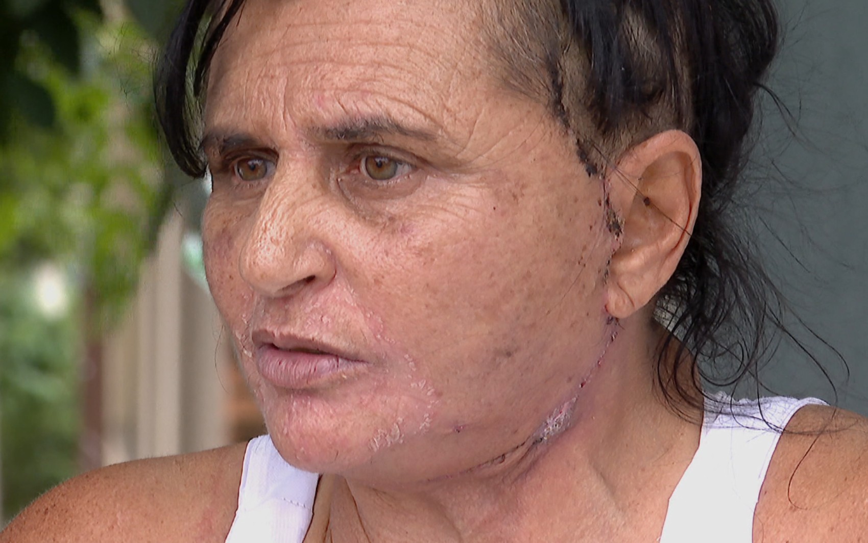 Professora que teve complicações em procedimento realizado por dentista comprou pacote estético para se presentear: 'Inocente'