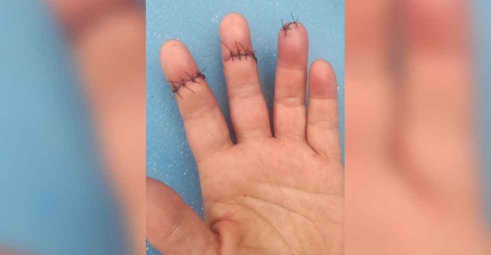 Dedos da mão da cozinheira de 45 anos de Araçatuba (SP) que foram cortados por um linha com cerol — Foto: Arquivo pessoal