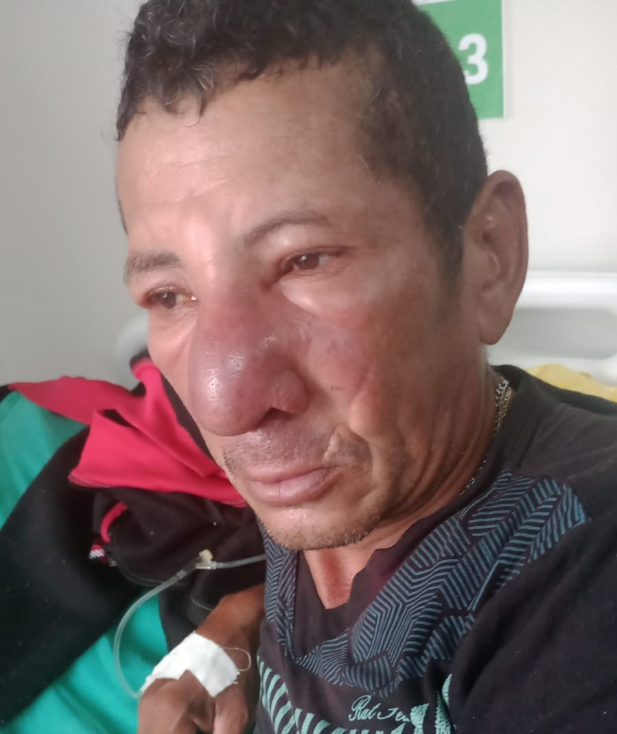 Diarista busca atendimento em hospital com dor e após três dias descobre lavas no nariz no Acre