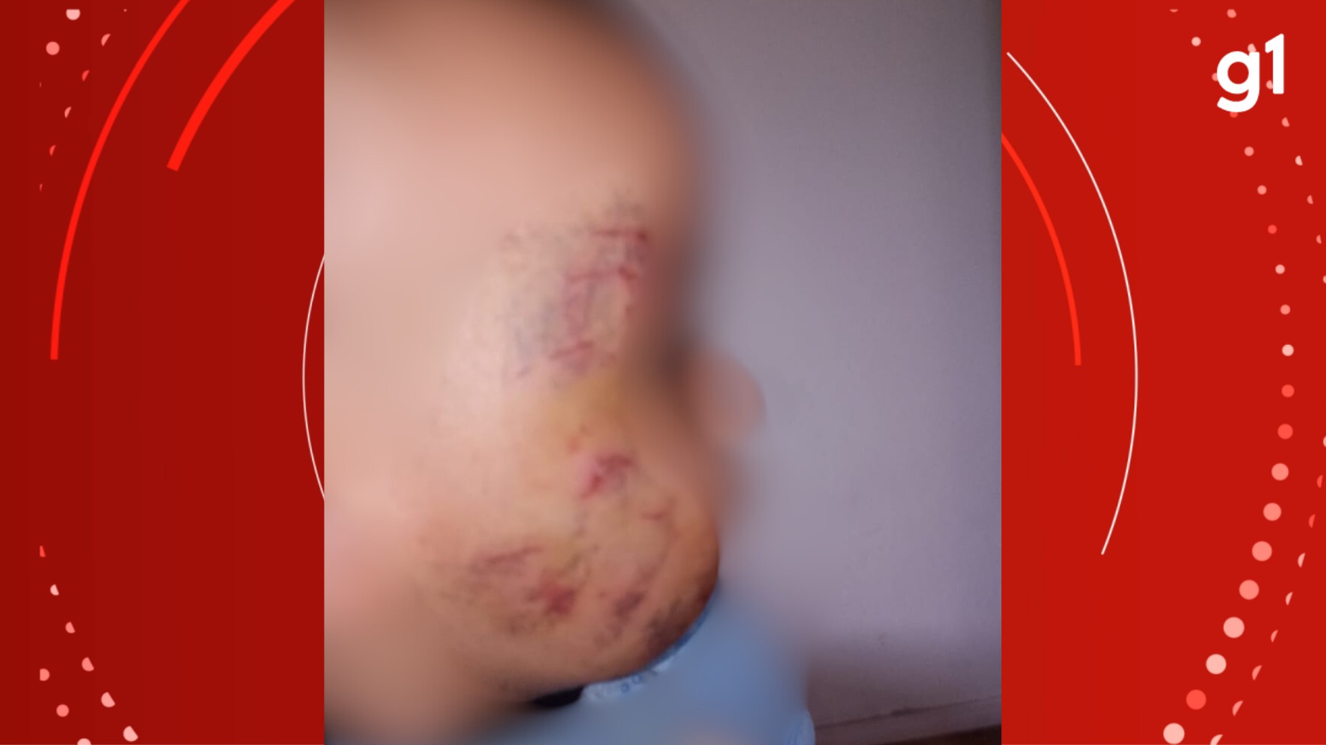 Bebê de 10 meses supostamente mordido por colega em escola de Viamão — Foto: Imagem cedida