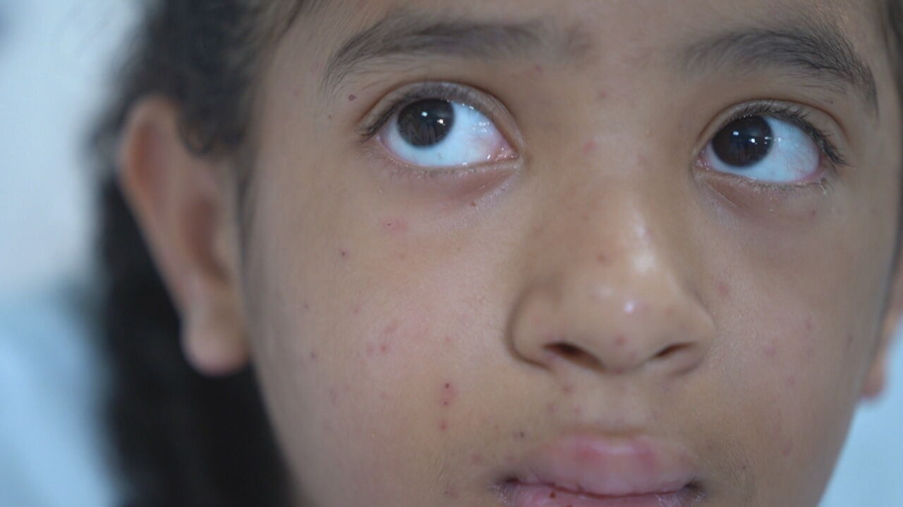'Estou bem melhor': menina atacada por enxame relata recuperação após levar mais de 100 picadas de abelha