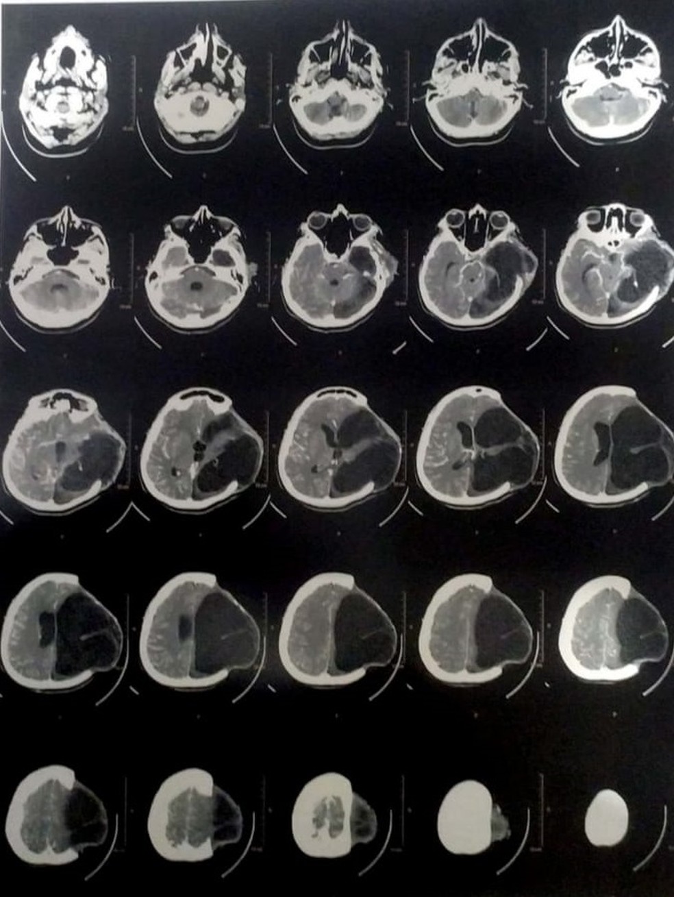 Tomografia do cérebro de Gislaine mostra sequelas da doença  — Foto: Reprodução/divulgação 
