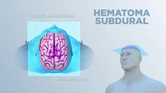 Hematoma subdural: entenda condição que atingiu o ator Tony Ramos  - Programa: Fantástico 