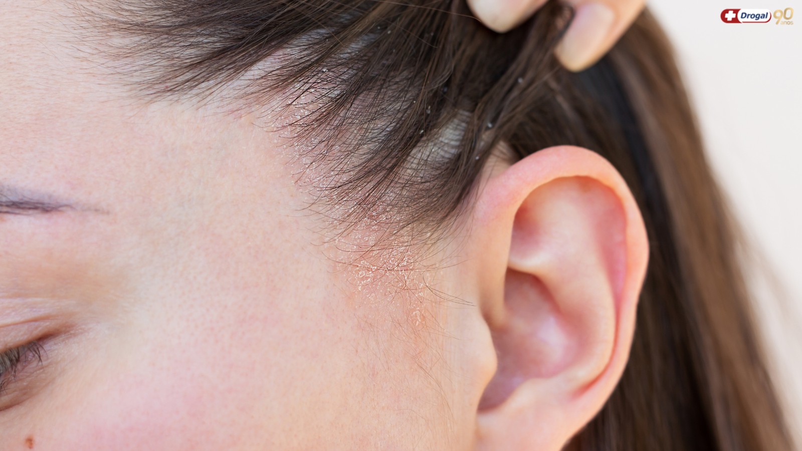 O que é bom para dermatite seborreica? Entenda sobre essa condição