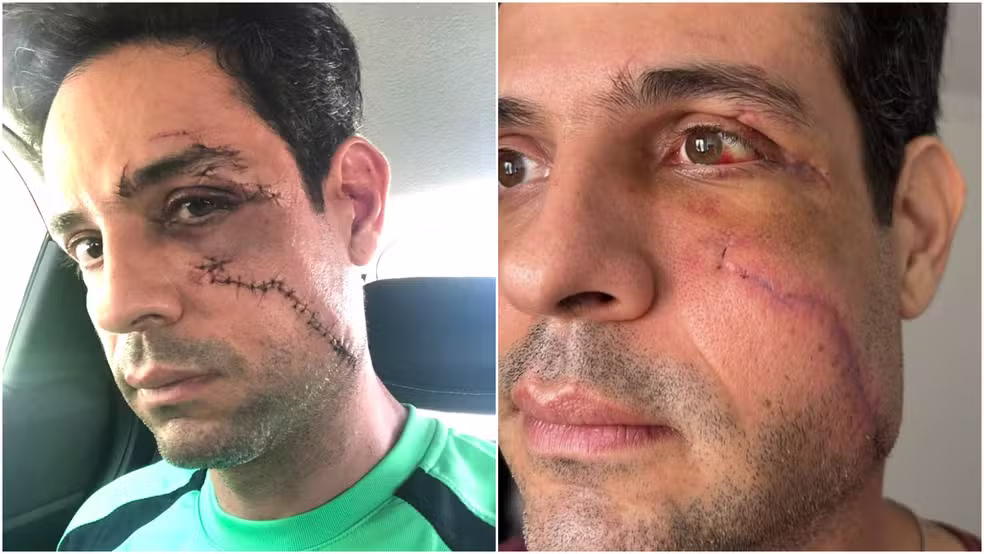 Empresário Bruno Paranaiba Ruguê segue em tratamento após ataque com copo de vidro que causou corte no rosto. — Foto: Arquivo pessoal