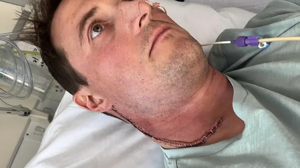 Durante a operação, os cirurgiões removeram 44 gânglios linfáticos de seu pescoço — Foto: Anthony Perriam