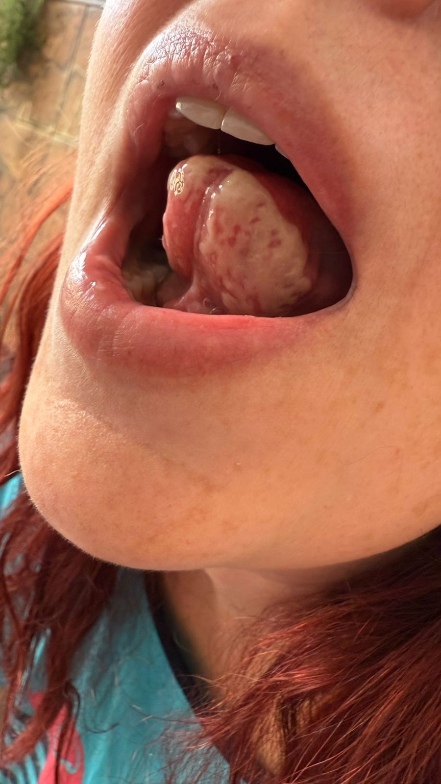 Mulher denuncia ter sofrido queimaduras e inchaço na boca após uso de pasta de dente Colgate