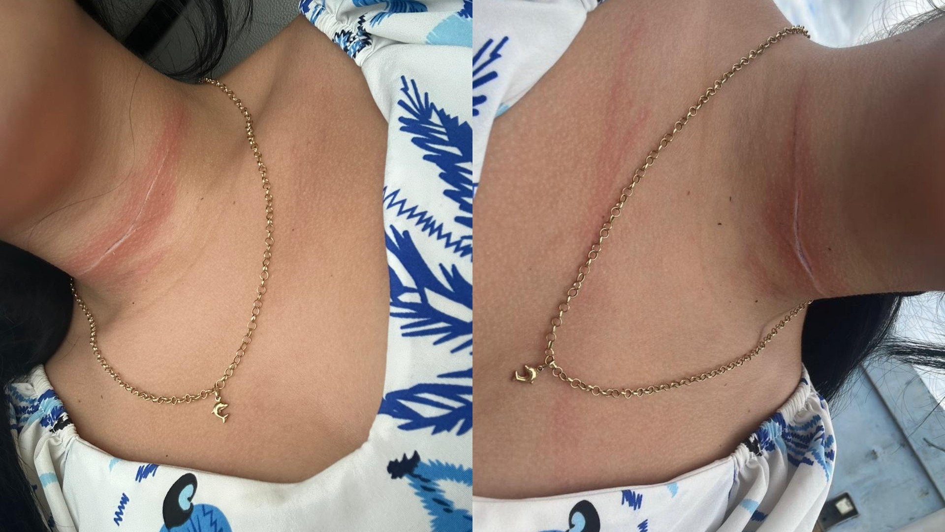 VÍDEO: Adolescente fica ferida após ser atingida por linha de pipa no pescoço em Santa Inês