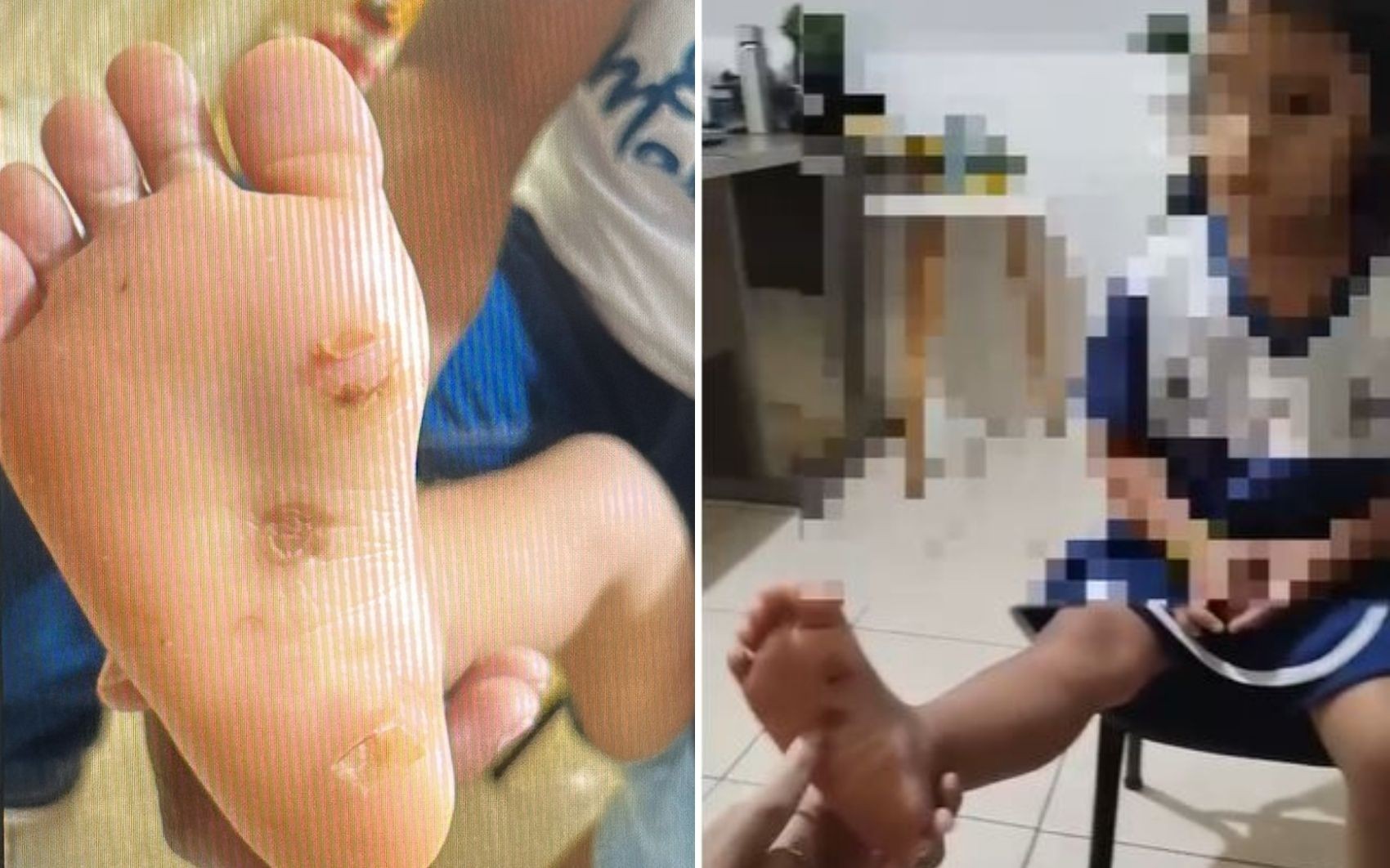 Mãe e padrasto são presos suspeitos de torturar e queimar com isqueiro menina de 4 anos