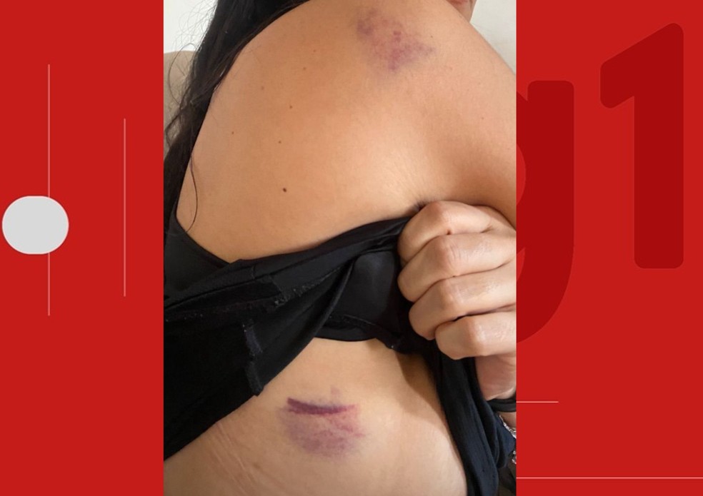 Vítima está com manchas roxas pelo corpo por conta das agressões — Foto: Arquivo pessoal
