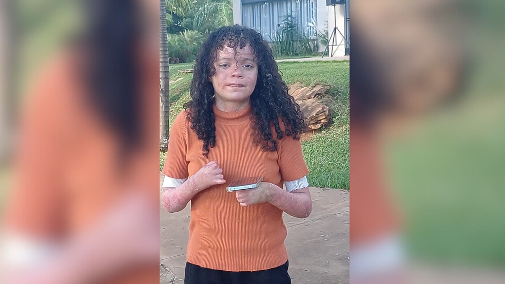 Elena Kessia Fávero é moradora de Olímpia (SP) e tem epidermólise bolhosa — Foto: Arquivo pessoal