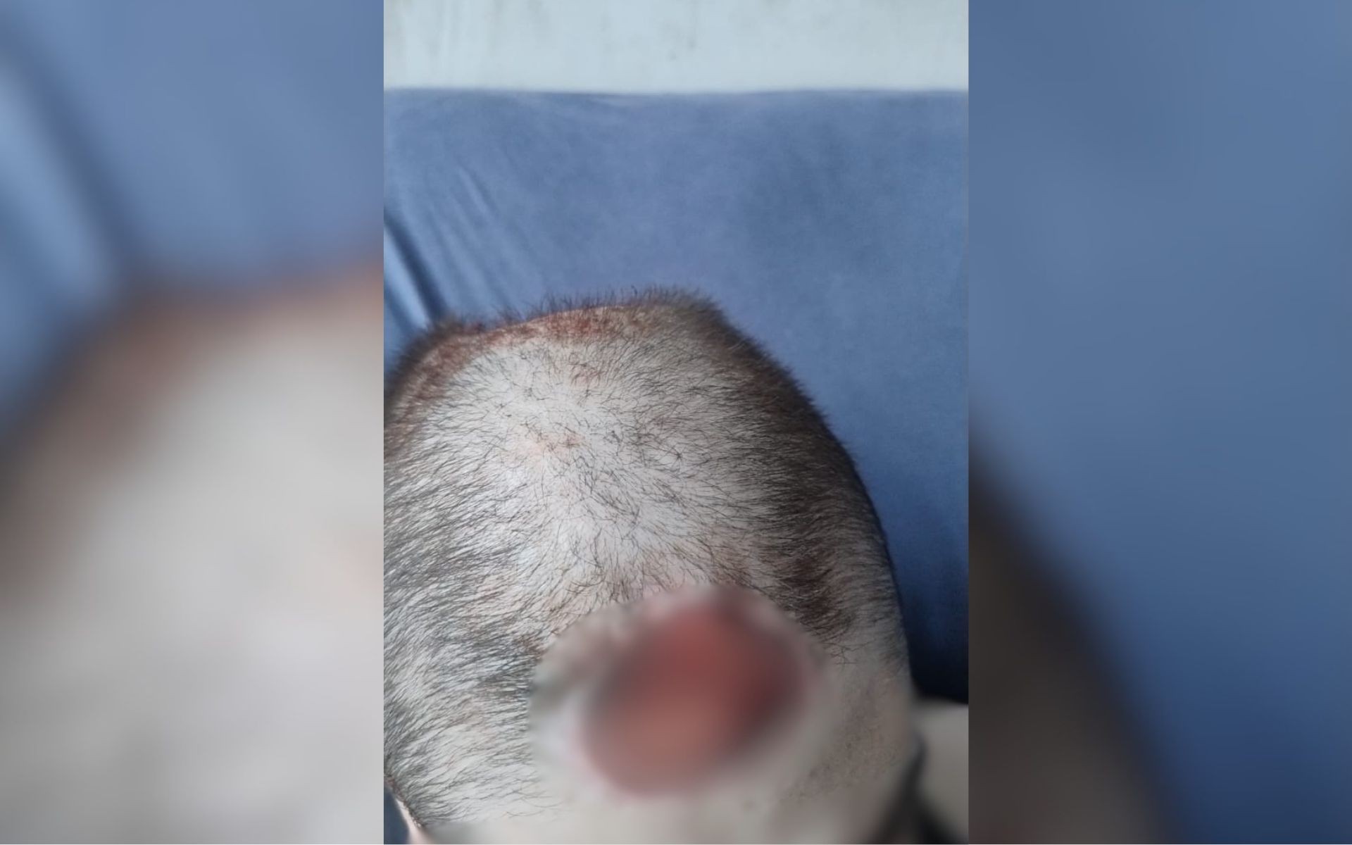 Adolescente autista com ferida exposta na cabeça aguarda cirurgia há 19 dias no interior de SP