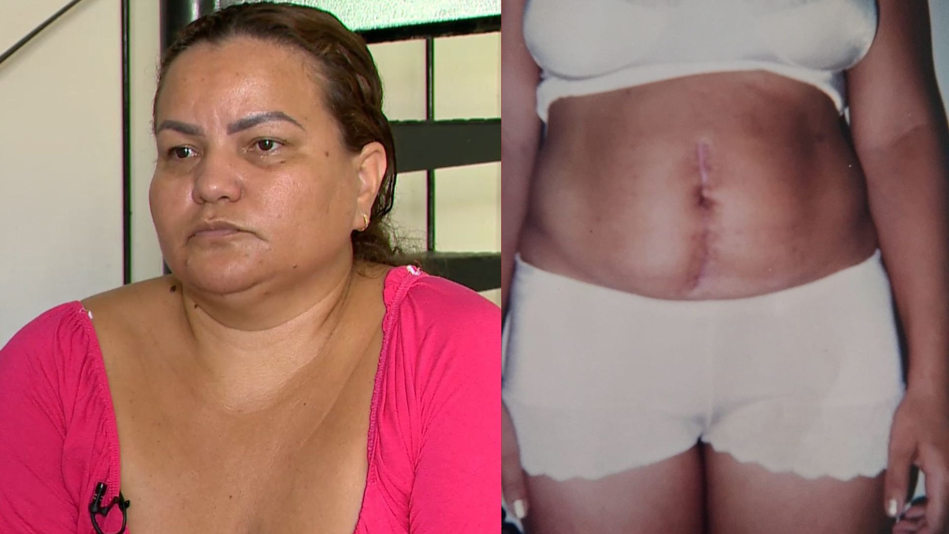 Mulher que ficou com restos de placenta e perdeu útero realiza 1ª perícia 22 anos depois: 'Tiraram de mim a possibilidade de gerar'