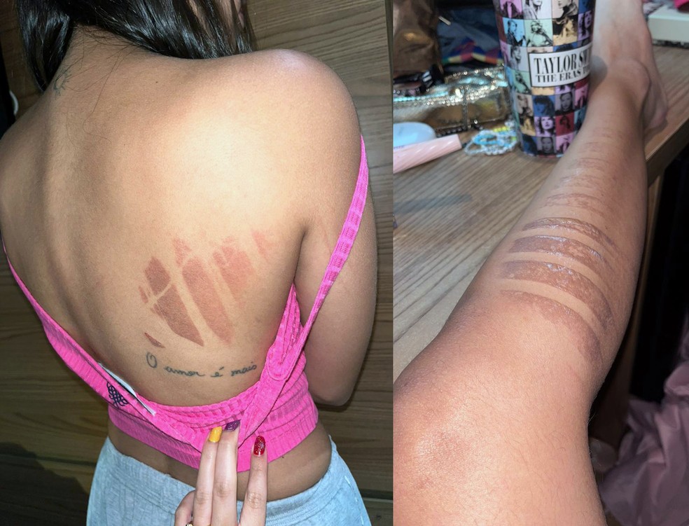 Kléssia teve costas e perna queimada durante show adiado de Taylor Swift — Foto: Arquivo pessoal