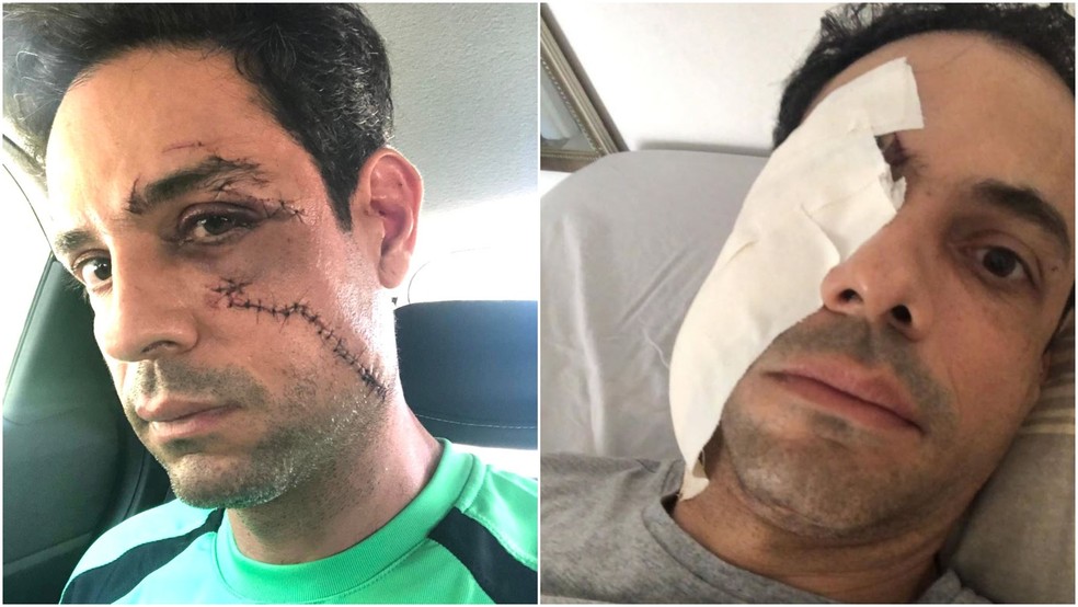 Bruno Paranaiba Rugue, dono de uma empresa de coquetéis, pegou 65 pontos no rosto após ser agredido por um convidado com um copo de vidro enquanto trabalhava em uma festa em um condomínio residencial de Fortaleza. — Foto: Arquivo pessoal