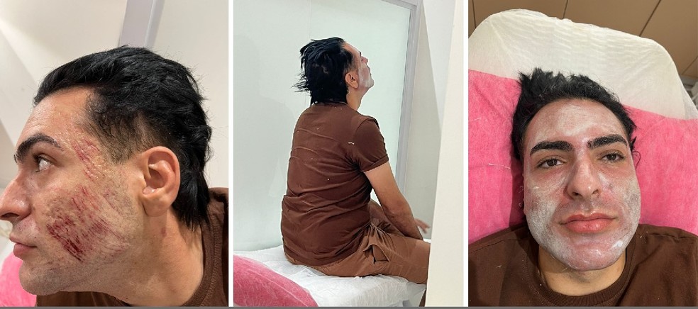 Henrique Chagas ficou com ferimentos no rosto após peeling de fenol. Essas fotos foram feitas pelo namorado dele — Foto: Reprodução/Divulgação/ Marcelo Camargo