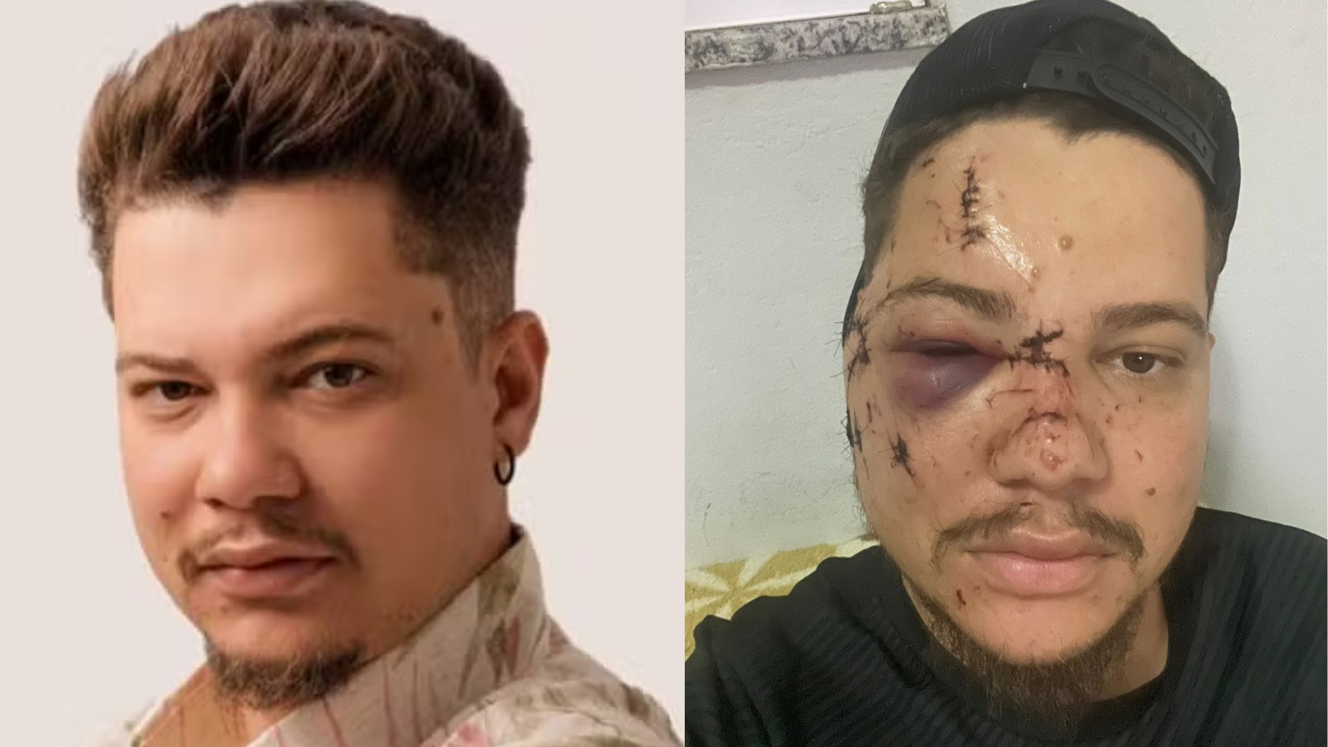 'Prejuízo de quase R$ 50 mil, cicatriz eterna e dor moral': cantor sertanejo desabafa depois de levar garrafada em show de réveillon em MG