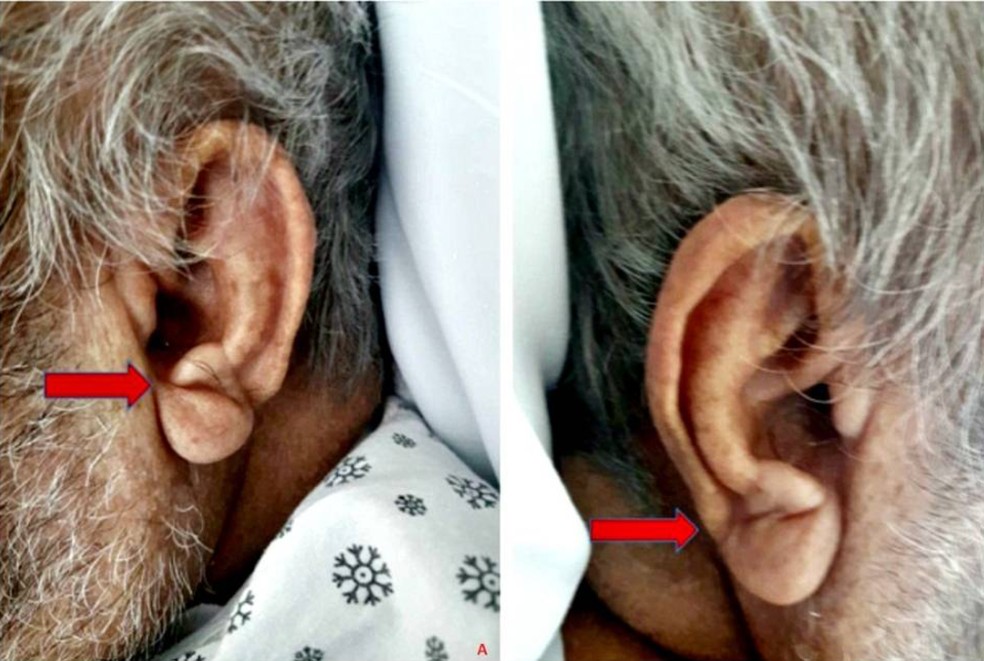 Sinal de Frank em orelha de idoso: imagem é parte de um relato de caso na Cureus Journal of Medical Science — Foto: Cureus/Divulgação