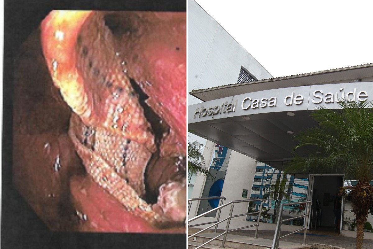 Gaze esquecida em cirurgia deixa idosa em coma e hospital é condenado em R$ 245 mil