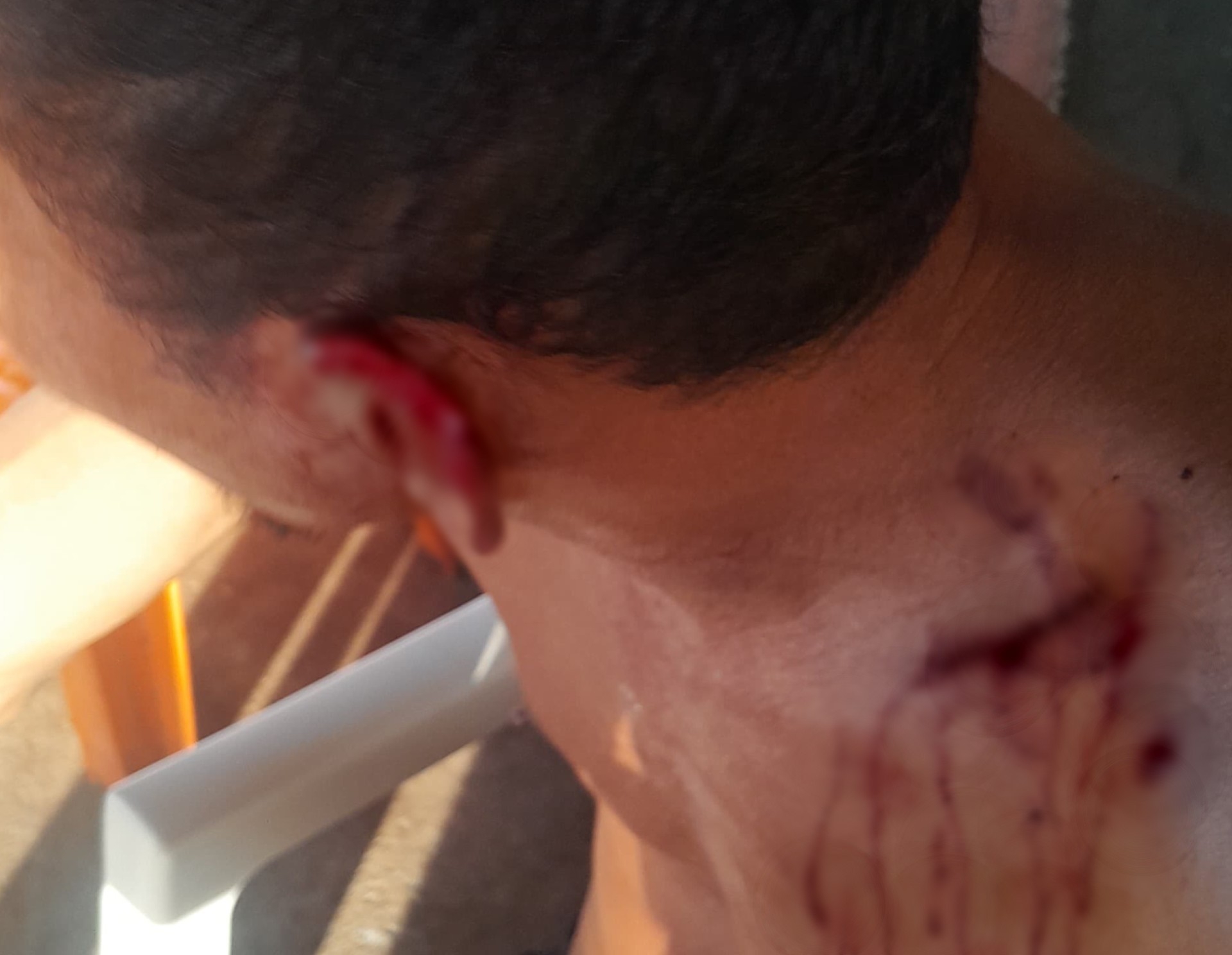 Mulher morde e arranca parte da orelha do marido ao encontrá-lo no bar com amiga, em Boa Vista
