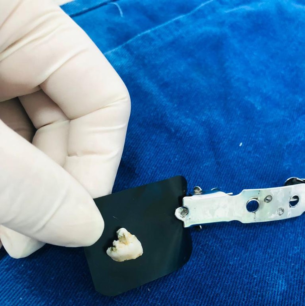 Dente achado em meio a marmita em Itajaí — Foto: Arquivo pessoal
