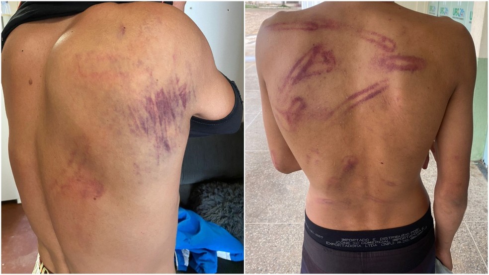 Vítimas de seguranças durante festa de Carnaval em Tianguá ficaram com marcas das agressões. — Foto: Arquivo pessoal