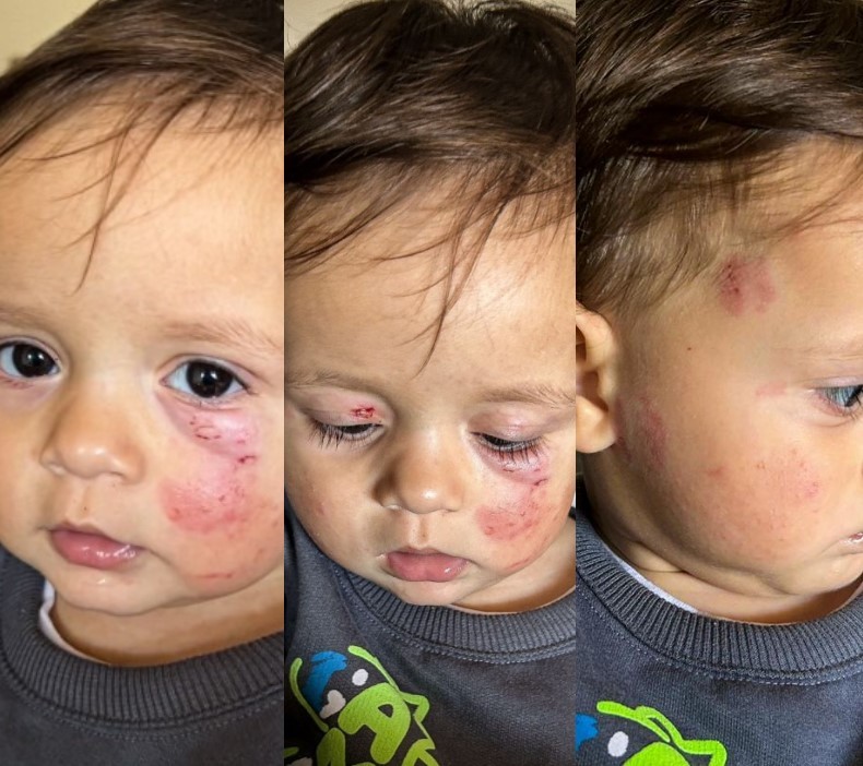 Bebê com rosto cheio de hematomas após ser mordido em creche de SC: O que se sabe e o que falta saber