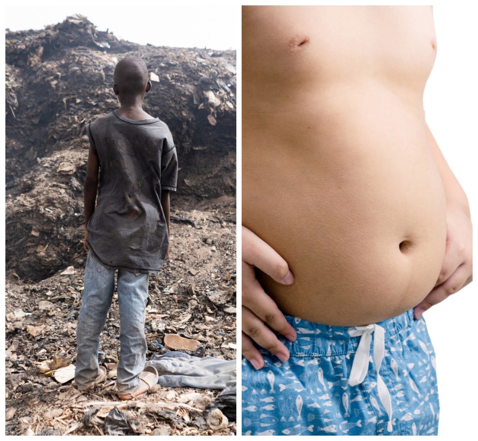 A desnutrição e a obesidade são duas doenças distintas e graves — Foto: Adobe Stock