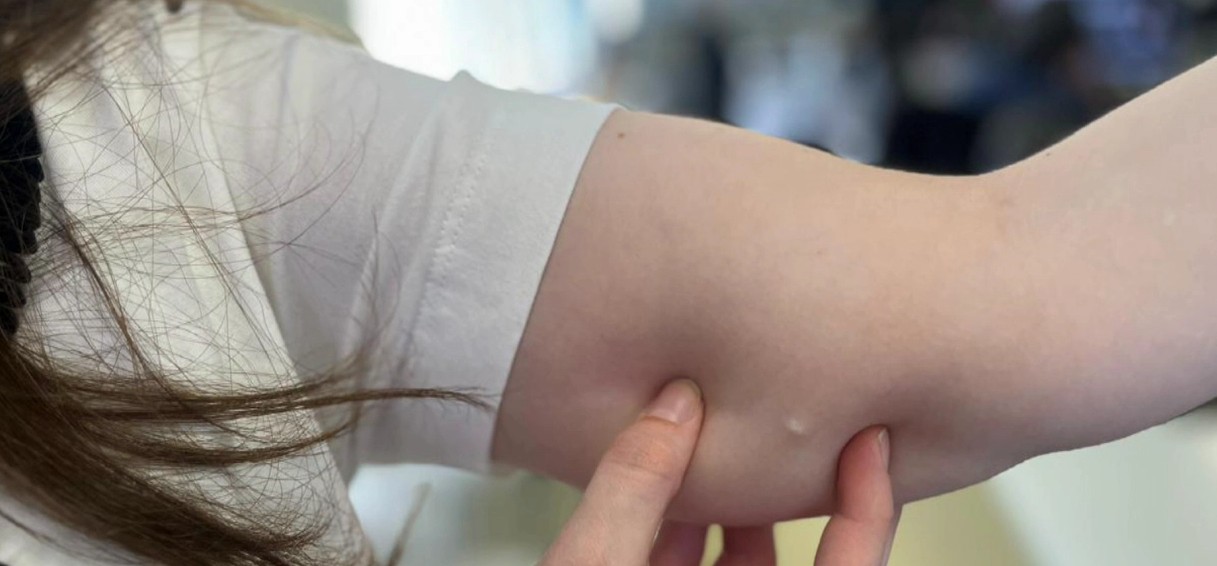 38 cidades do Paraná passam a oferecer de graça pelo SUS implante contraceptivo de até R$ 4 mil; veja como funciona