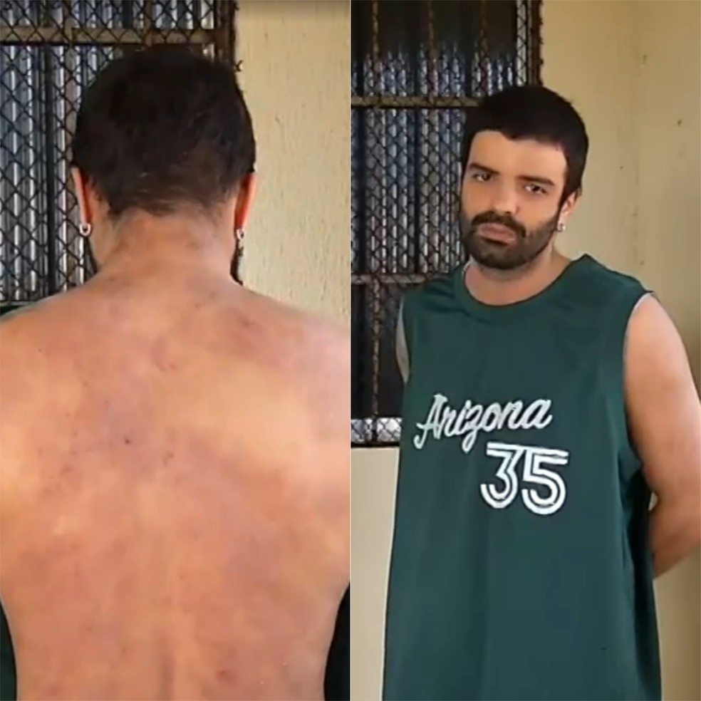 Moisés Melo sofre com dermatite atópica e precisa de tratamento de R$ 150 mil — Foto: Reprodução/Inter TV Cabugi