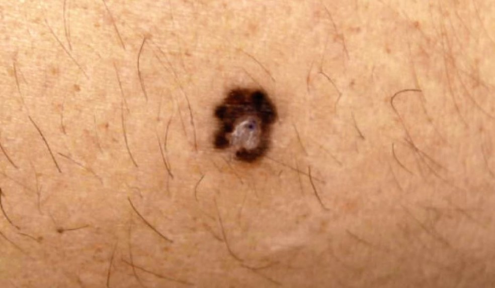 Melanoma é a forma mais agressiva de câncer de pele — Foto: Reprodução/EPTV