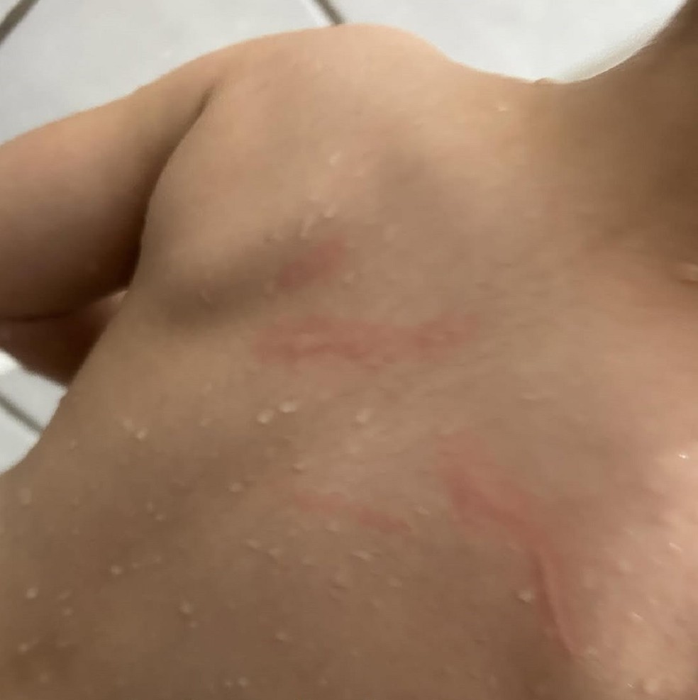 Mãe conta que hematomas permaneceram no dia seguinte — Foto: Arquivo pessoal