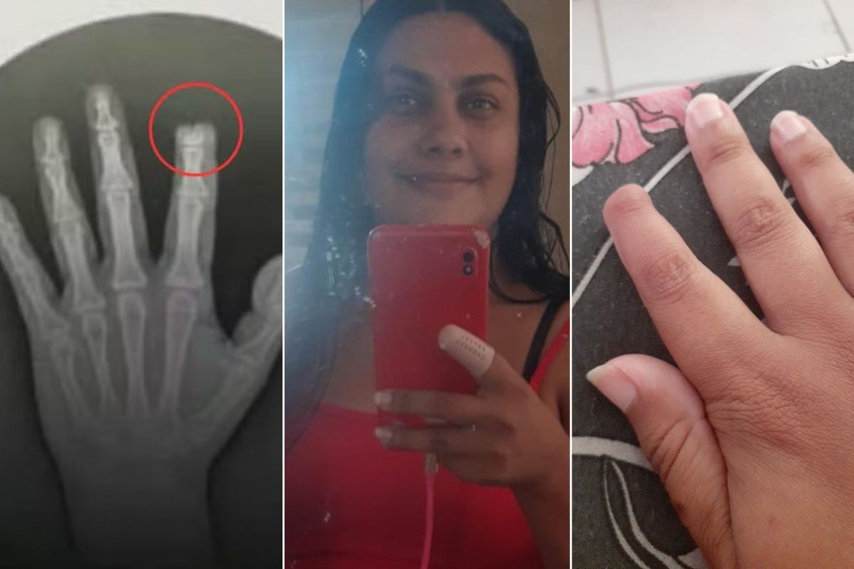 Mulher que teve dedo arrancado a dentadas durante briga no Carnaval diz que folia nunca será a mesma