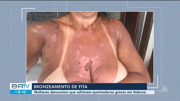 Sobe para dez o número de denúncias de mulheres contra clínica após  queimaduras durante bronzeamento com fitas na BA, Bahia