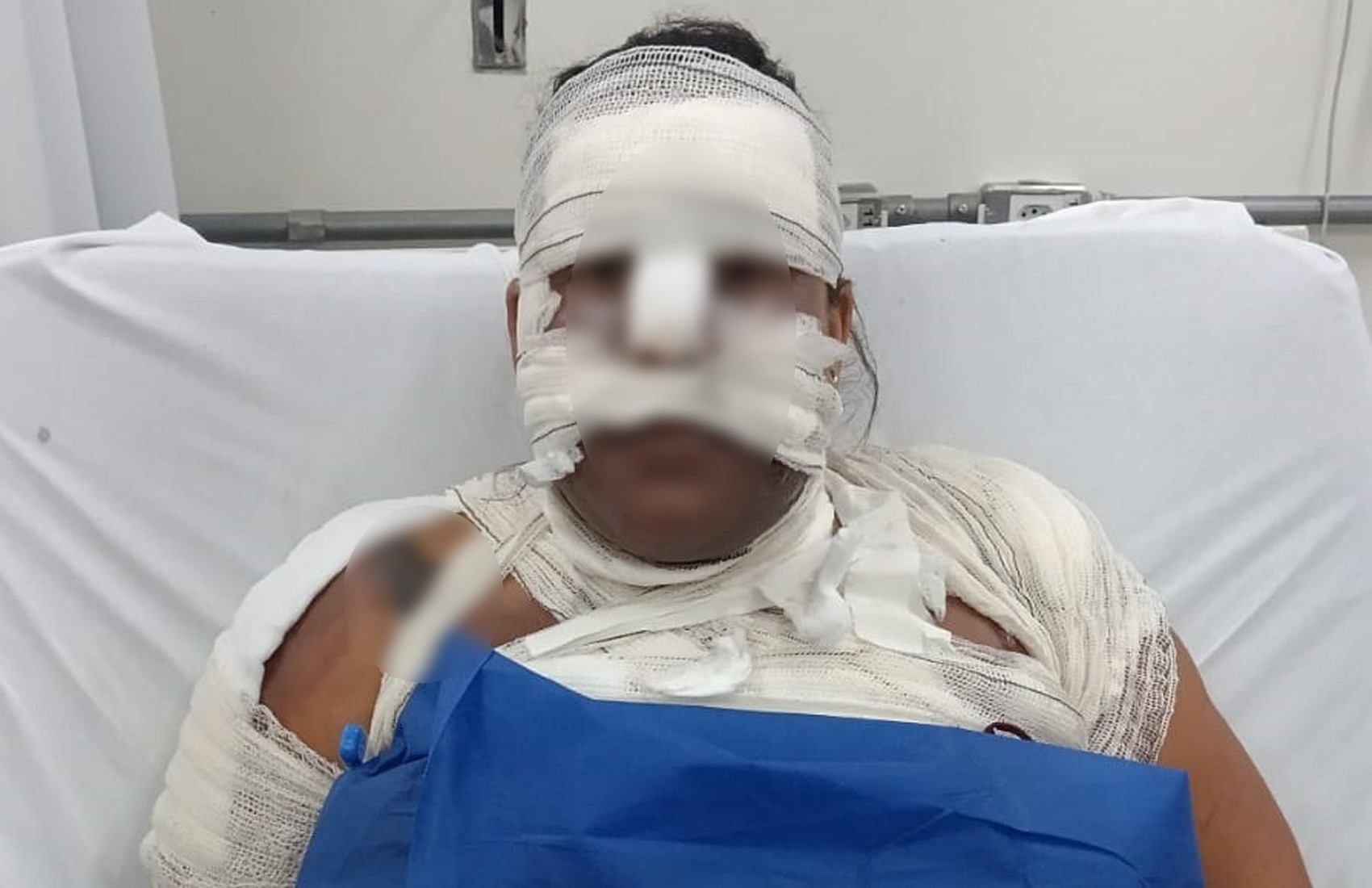 Homem é preso por suspeita de jogar chá quente e causar queimaduras graves na ex