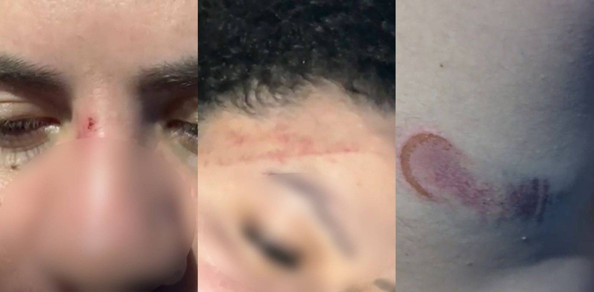 Mulher que levou tapa de PM em Florianópolis mostra hematomas: 'Chegaram jogando spray de pimenta'