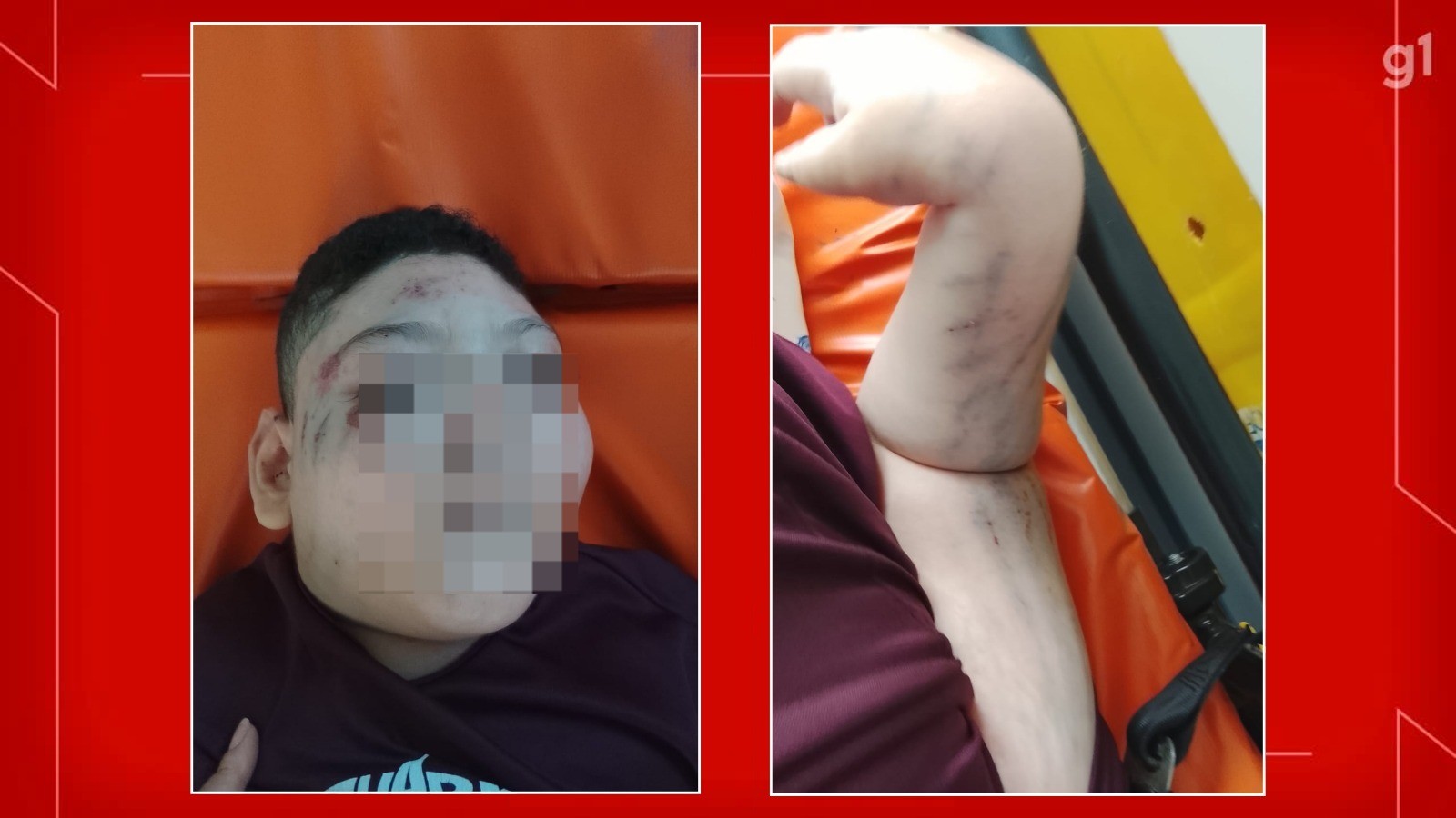 Criança Cadeirante na UTI Após Queda em Metro; Acessibilidade em Pauta