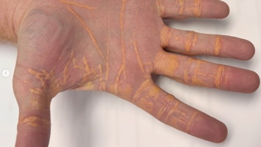 Bombou no g1: homem 'vazou' colesterol após dieta carnívora - Foto: (Divulgação/JAMA)