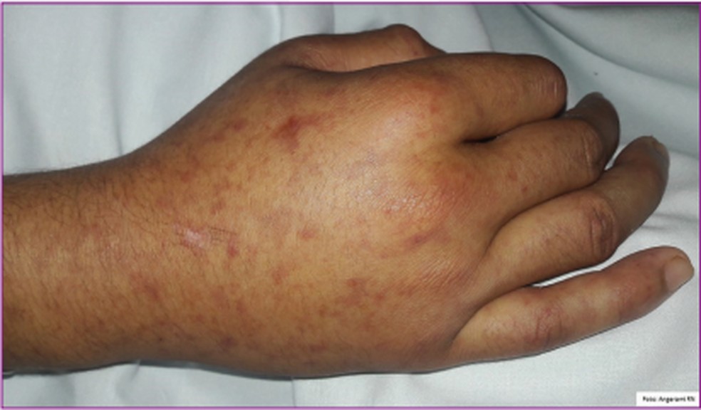 Exantema e edema de mão na febre maculosa brasileira — Foto: Angerami et al. (2021, p. 1036) 