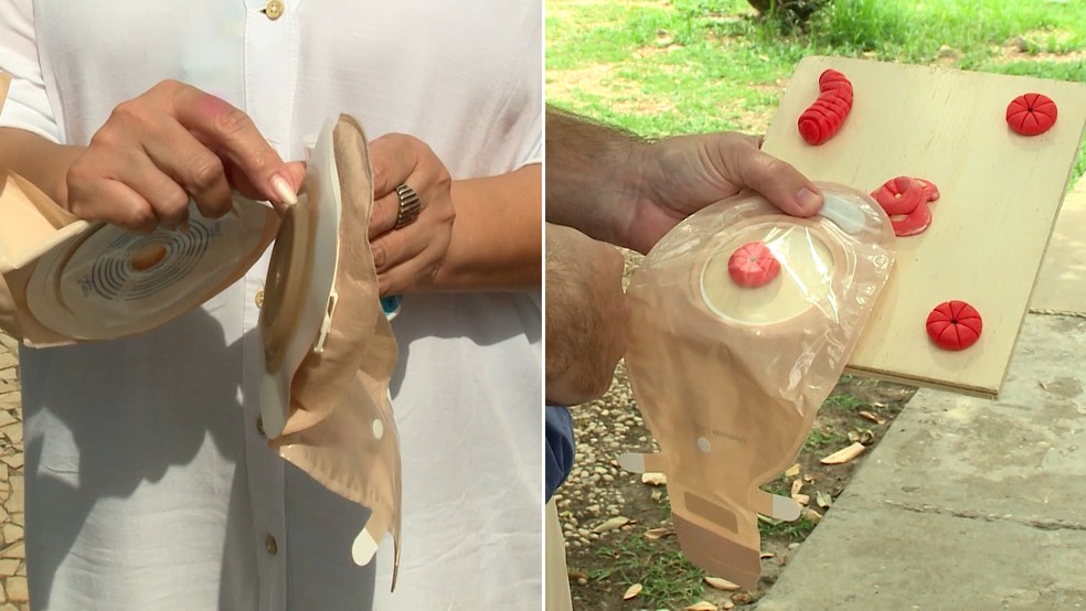 Pacientes denunciam falta de bolsas de ostomia do SUS em Teresina — Foto: Montagem g1 PI/ TV Clube