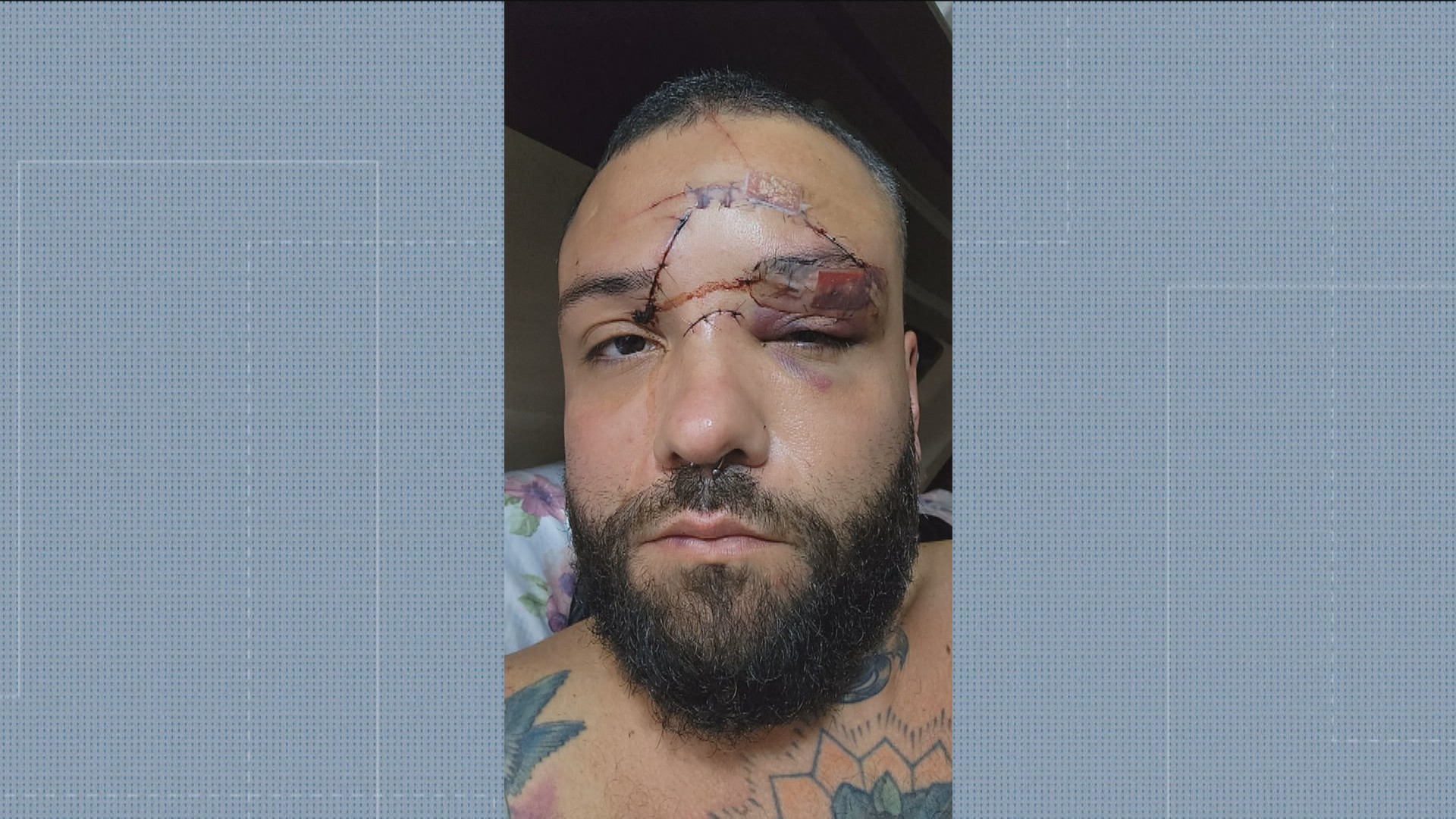 Designer denuncia agressão por homofobia em bar de Mesquita; vítima levou 35 pontos no rosto 