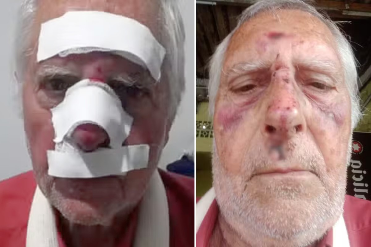 'Caí de cara no chão': idoso de 77 anos fratura o pulso e denuncia calçada e iluminação em São Vicente