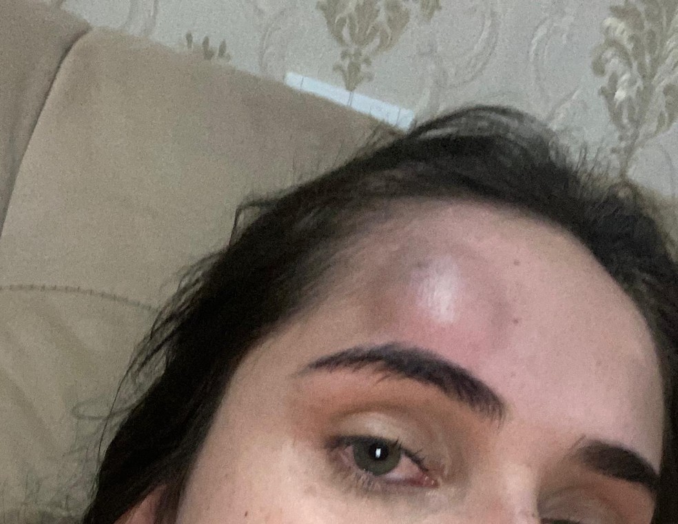 Palu Vitória mostra ferimento após levar coronhada na cabeça — Foto: Arquivo pessoal
