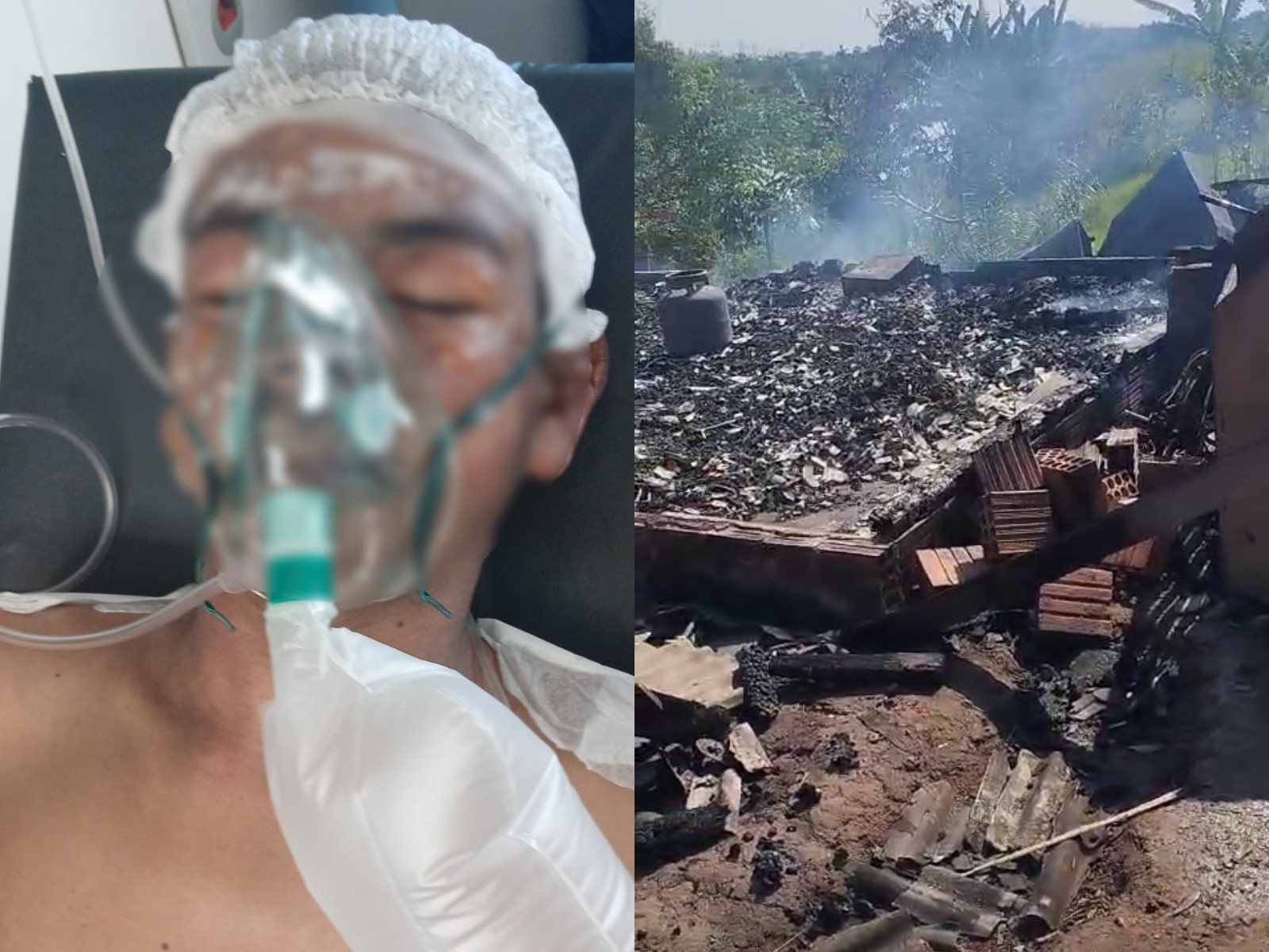 Adolescente de 14 anos fica com 40% do corpo queimado ao salvar irmãos de incêndio no Acre; VÍDEO