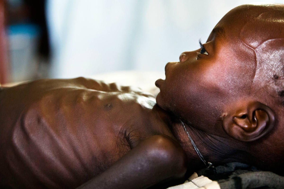 ONU diz que 1,4 milhão de crianças correm risco iminente de morrer de fome Mundo G1