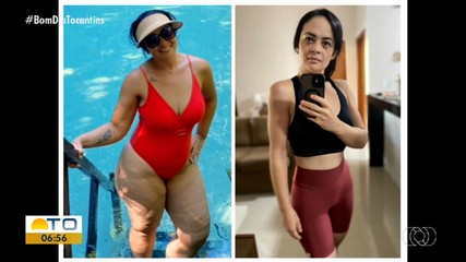 Médico explica como tratar sintomas e controlar desconforto do lipedema