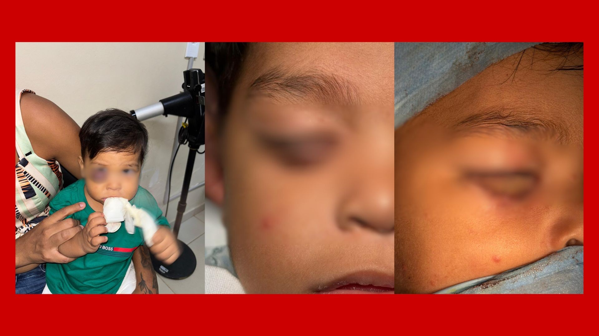 Criança de 1 ano passa por cirurgia complexa para reconstruir pálpebra em hospital do DF: 'Alívio', diz mãe